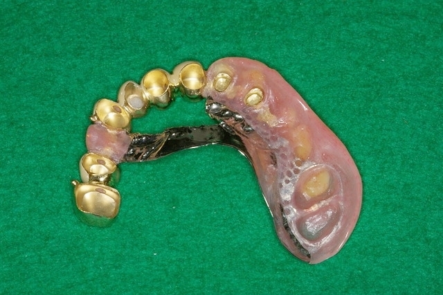 ソフトアタッチメント義歯