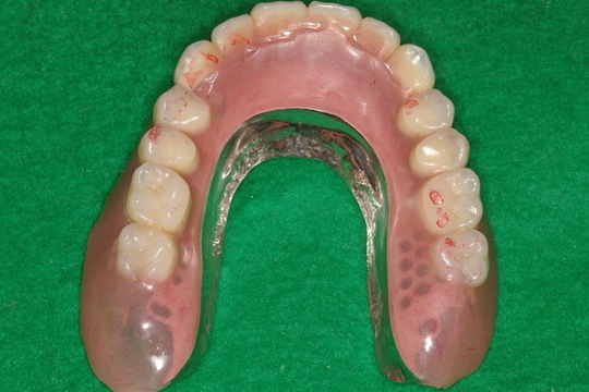 噛みやすい最新入れ歯の種類と値段 - 新川八丁堀入れ歯専門歯科外来